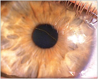 Iron Staining in Corneal Ectasia: Keratoconus Versus Pellucid Marginal Degeneration