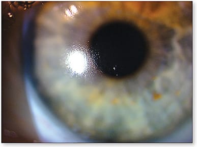 Figure 1. Contact lens surface with poor wettability.