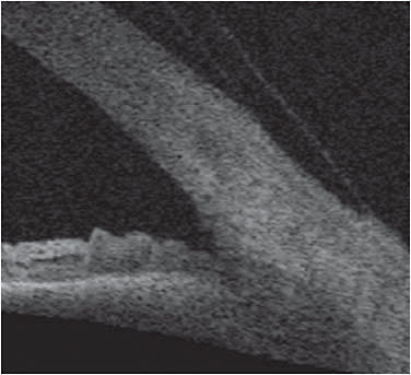Figure 5. OCT image of the edge of a smaller-diameter scleral lens resting upon the sclera. Image courtesy of Greg DeNaeyer, OD