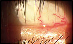 Figure 4. “Toothpaste sign” upon digital expression of a patient who has non-obvious MGD.