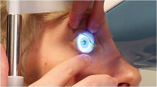 Figure 1. Cobalt blue light reflected off the ocular surface provides the data for processing the shape of the cornea and sclera. Image courtesy of Jason Jedlicka, OD