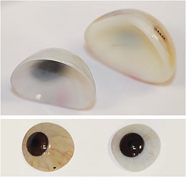 Figure 3. Rigid ocular prosthetic devices. The scleral shell (top left, bottom right) is typically used in cases of an eviscerated eye or a shallow socket. It is lightweight and has the best motility. The reform device (top right, bottom left) is used in cases of enucleation both with and without an implant. Its motility is acceptable for smaller devices and provides excellent cosmesis.