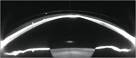 Figure 7. An 18mm scleral lens on the right eye.