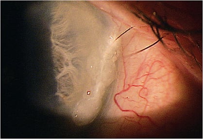 Figure 1. Upper eyelid lash trichiasis that requires frequent lash epilation and/or surgery might benefit instead from scleral lens wear.