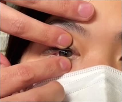 Figure 3. Custom soft lens removal using the “pop-off’ method.