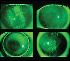 Figure 2. The many “faces” of foreign body tracking.