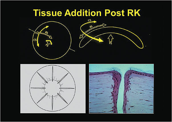 Figure 2. The stresses present in the cornea include a posterior IOP stress (PS), radial stress (RS), and a circumferential stress (CS).