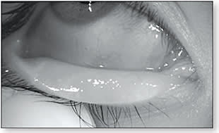 Figure 1. Severe meibomian gland dropout of the lower lid.