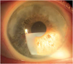 Figure 1. Slit lamp exam showing superior peripheral SND OD.Image courtesy of Gregory W. DeNaeyer, OD.