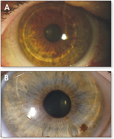 Figure 7. (A) Slight temporal decentration of a multifocal hybrid lens. The vision will be poor at both distance and near. Steepening the skirt curve by one step will re-center the lens. (B) Severe superior decentration of a multifocal hybrid lens. This is often a problem of inadequate sagittal depth of the lens. Steepening the base curve of the GP portion is the best way to re-center the lens.