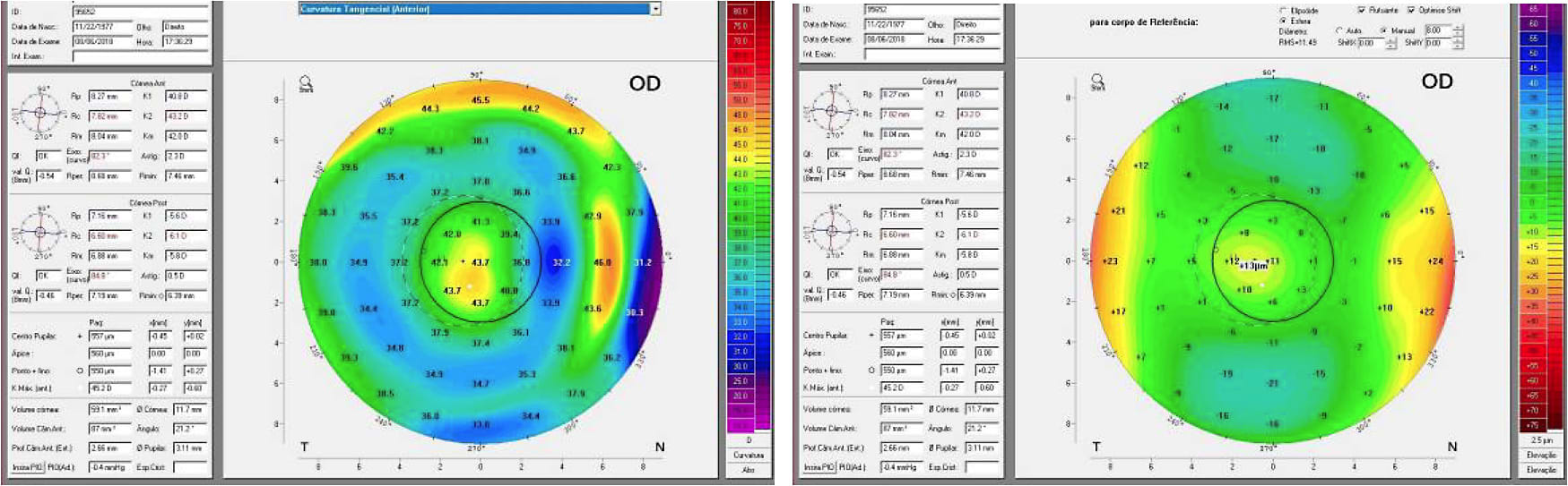 Figures 7 and 8. OD anterior tangential curvature and anterior elevation maps.
