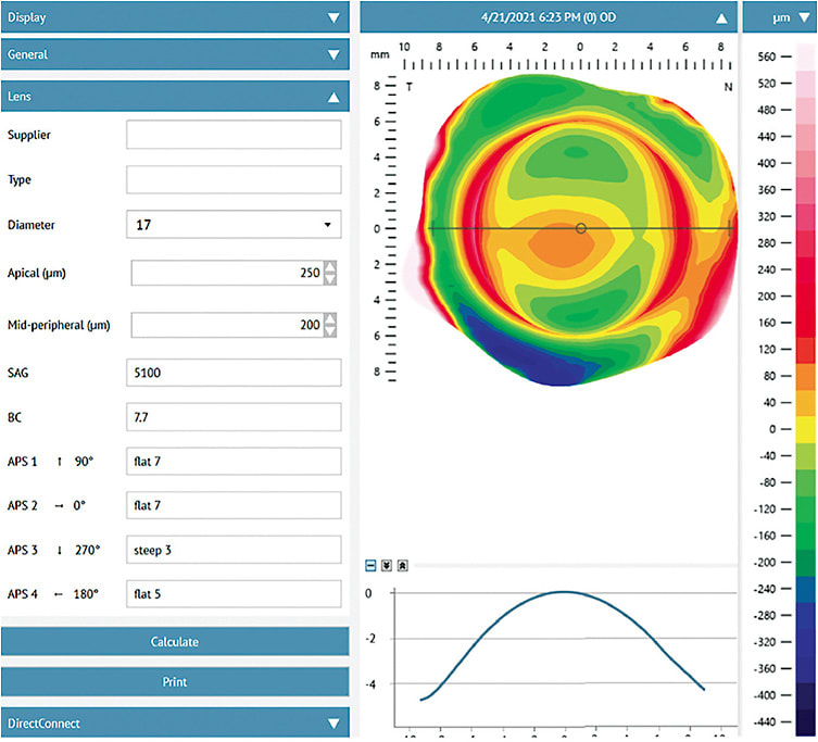 Figure 10. Using the lens-fitting suggestions from profilometry, you can simply order the lens with the parameters given and use this as your starting point for the fitting process. Shown here is an eye that would require a quadrant-specific design. Ordering empirically allows your first lens on an eye to be a reasonable starting point for a mildly complex design when a diagnostic lens is not available. Image courtesy of Jason Jedlicka, OD