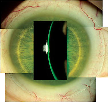Figure 16. Free-form scleral lens designed from profilometry. Central vault and peripheral edge fit were both ideal and resolved all of the patient’s issues with her prior lens. Image courtesy of Jason Jedlicka, OD