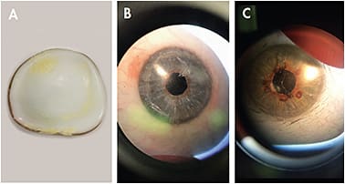 Figure 5. Common ocular prosthetic device complications and etiologies include deposits (normal wear and poor cleaning) (A); scratches (abrasive cleaning agents or dropping the device) (B); and delamination/cracks (excessive temperature changes, dropping the device, or old age of the device) (C).