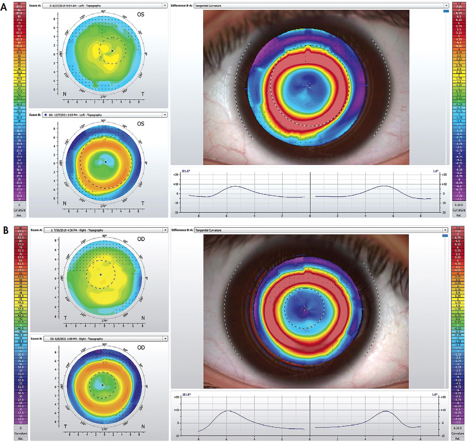 Figure 3. Topography maps showing post-wear, well-centered treatment zones with ortho-k.