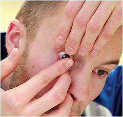 Figure 1. A hybrid lens should be placed directly onto the center of the cornea or on the center of the &amp;#x201C;colored part of the eye&amp;#x201D; if instructing a patient.