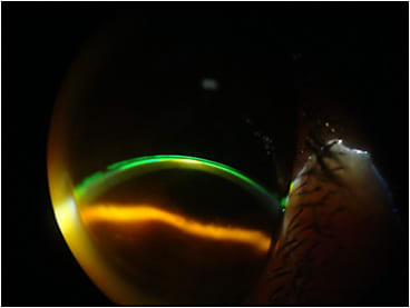 Figure 2. Mild touch at the apex because of the scar.