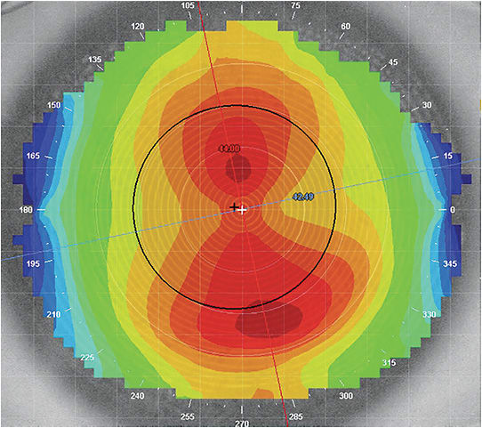 Figure 1. A symptom of higher amounts of astigmatic refractive error is that the vision fluctuates upon blink due to lens rotation, despite stabilization methods built into the lens.Photo courtesy of Stephanie Ramdass, OD, MS, MBA.