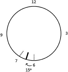 Figure 4. The soft toric contact lens is rotated 15º to the left. The position of the laser marking is situated halfway between 6 o’clock and 7 o’clock.