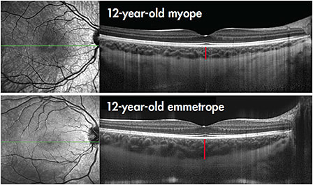 Figure 2. Example of high-resolution, foveal-centered OCT scans from a 12-year-old myopic child (spherical equivalent –2.00DS, axial length 24.17mm) [top]) and a 12-year-old emmetropic child (spherical equivalent +0.25DS, axial length 23.87 [bottom]). Note the substantially reduced thickness of the choroid in the myopic child (mean subfoveal choroidal thickness of 238µm) compared to the emmetropic child (mean 392µm). The red line illustrates subfoveal choroidal thickness measures.