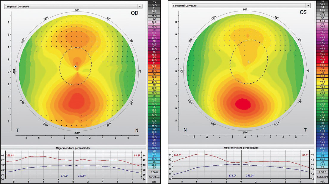 The patient’s corneal topographies show unusual corneal diameter and shape, necessitating a specialty lens fit.