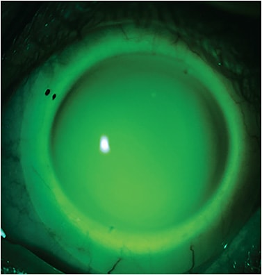 Figure 14. Scleral lens on the left eye with internal toricity. The fit is improved in every way. Profilometry provided the data to optimize the fit. Image courtesy of Jason Jedlicka, OD