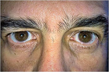 Figure 8. The patient took this photo and sent it to us recently.