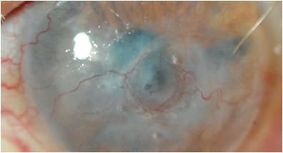 Figure 6. Left eye of a SJS patient with central bullae, microcystic corneal edema, increased haze, and vascularization as result of a corneal melt complication from central touch/rubbing with a 16mm, low-clearance scleral lens, which settled over time.
Images courtesy of Karen G. Carrasquillo, OD, PhD