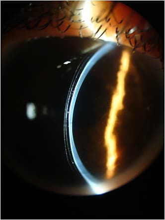 Figure 6. Slit lamp view of the vertical turned right for better view.