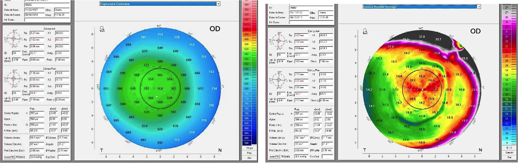 Figures 9 and 10. OD corneal thickness and corneal density average maps.