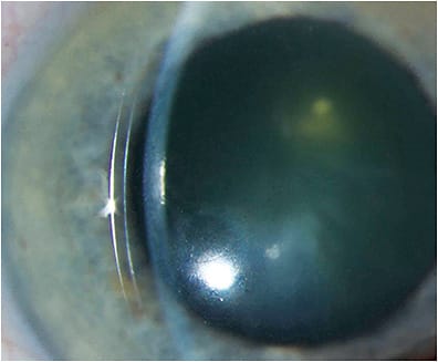 Figure 1. Scleral lens in place on right eye demonstrating 470 microns of central corneal clearance. 
Images courtesy of Karen G. Carrasquillo, OD, PhD