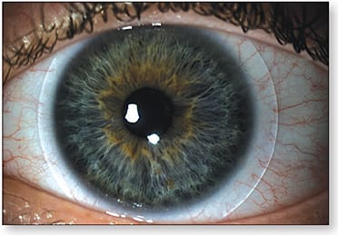 Figure 2. Hybrid lens fit on an eye with a 12.5mm HVID.View video here.