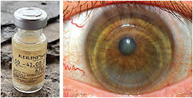 Figure 1. The Flexlens high myopia design. SCL Rx OD: 8.50 –41.00 15.00. Photo courtesy of The Contact Lens Museum Library.
