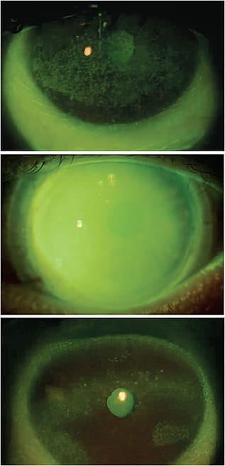 Figure 1. A patient who has Sjögren’s and who was successfully managed with cryopreserved amniotic membrane tissue. The patient’s subjective complaints and objective corneal staining improved.