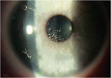 Figure 3. Debris centrally under a scleral lens.