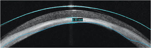 Figure 7. OCT image of 19.5mm lens over a SJS eye status post-corneal melt. The lens has a center thickness of ~250µm, two ventilating channels at 3 o’clock and 9 o’clock, and a haptic fenestration at 12 o’clock. Central clearance remained at ~600µm.
Images courtesy of Karen G. Carrasquillo, OD, PhD