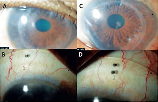 Figure 3. Original grafts of ~40 years in both OD/OS secondary to keratoconus. The patient was fitted with and has been wearing scleral lenses for 11 years in the following parameters: 19.5mm (A, B) in the right eye and 20.0mm (C, D) in the left eye (Dk ~140, center thickness ≤ 260µm OD/OS). No hypoxia-related complications were observed despite one of the lenses having a central clearance of ~600µm.
Images courtesy of Karen G. Carrasquillo, OD, PhD
