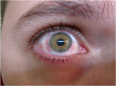 Figure 6. Localized hyperemia after two hours with the scleral trial lens.