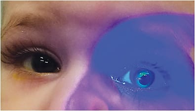 Figure 1. Increased intraocular pressure from aphakic glaucoma may cause the contact lens fit to appear steep.
Courtesy of Alexandra Williamson, OD