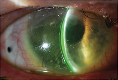 Figure 1. Scleral lens in a patient who has corneal neovasculatization secondary to GVHD. Image courtesy of Marcus R. Noyes, OD
