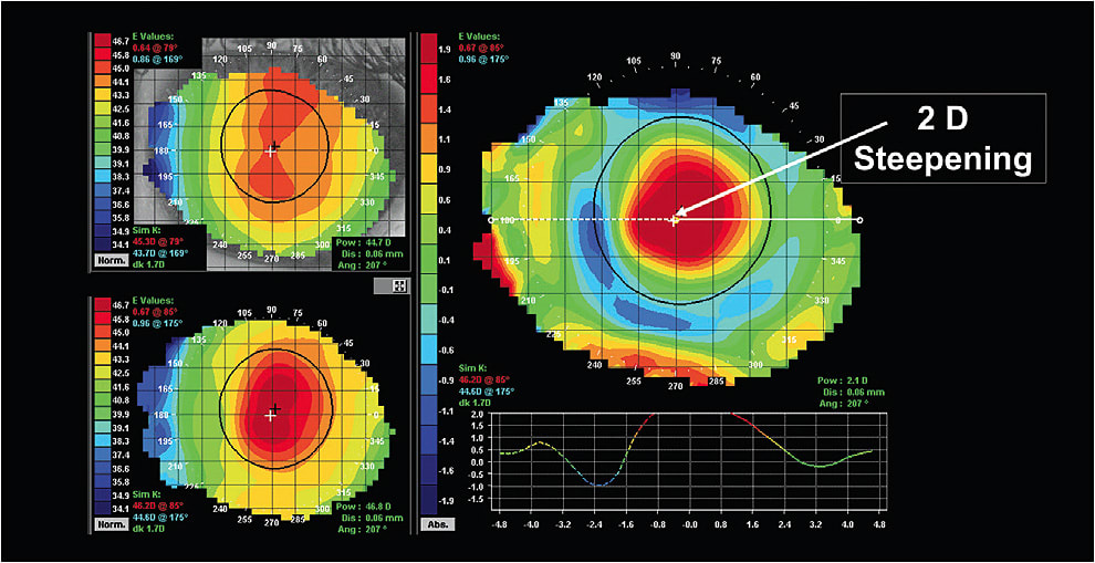 Figure 1. A post-hyperopic topography map shows steepening in the central cornea and flattening in the midperipheral cornea.
