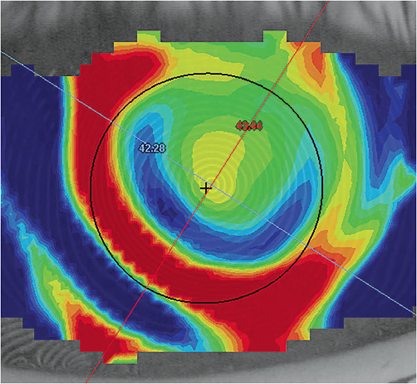 Figure 1. Spherical ortho-k lens designs on toric corneas may result in poor treatment due to lens decentration.