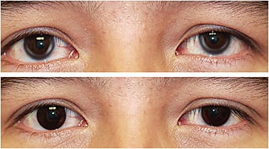 Figure 1. Basic tinted soft prosthetic lenses. Bilateral arcus (top) masked by pinhole tinted soft prosthetic contact lenses (bottom).