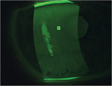 Figure 2. Epithelial erosions from severe dry eye disease would benefit from therapeutic coverage and protection with a scleral lens.