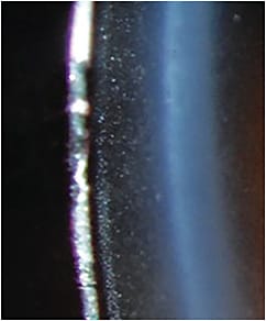 Figure 2. A cloudy tear reservoir is observed under a lens with excessive clearance.