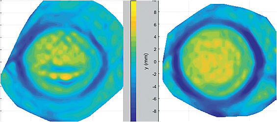 Figure 3. Normal eye on the left compared to an eye that was wearing a soft contact lens one hour prior to scanning. Note the blue “indentation” left by the soft lens even one hour after removal. Image courtesy of Jason Jedlicka, OD