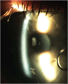 Figure 3. Significant fogging due to mucin accumulation in the fluid reservoir of a scleral lens. Image courtesy of Aaron B. Zimmerman, OD, MS