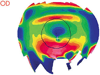 Figure 1. Topographical map of keratoconus OD.