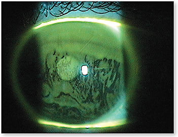 Figure 1. Demonstrate the tears breaking up so patients can understand how that relates to their contact lens comfort.