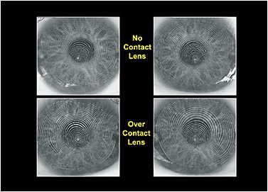 Figure 3. Evaluation of the corneal mires with no contact lens versus over a soft contact lens.